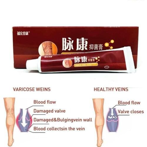 1pc Varicose Veins Treatment Cream Relief Veins Pain Phlebitis Legs Varicosity Angiitis Remedy Ointment Health Care