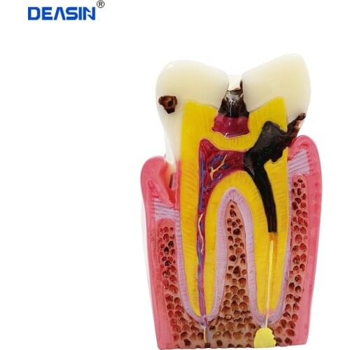 1pcs dental teeth model 6 Times Caries Comparation Study denture Tooth models Dentistry product