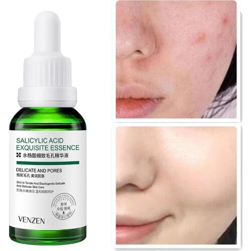 Aloe Salicylic Acid Acne Treatment Serum Oil Control Shrink Pores Face Essence Hyaluronic Acid Moisturizing Brighten Skin Toner