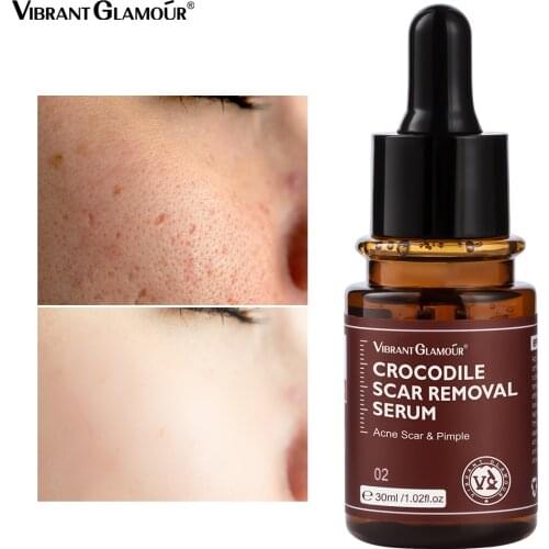 VIBRANT GLAMOUR Crocodile Scar Repair Serum Acne Treatment Stretch Marks Removal Acne Scar Whitening For Spots Skin Care 30ml