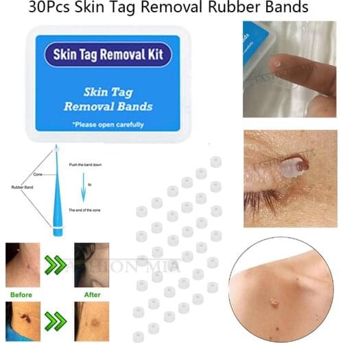 30Pcs High Quality Skin Tag Removal Rubber Bands Micro Band Non Toxic Face Care Mole Wart Tools for skin tag remover wart Remove