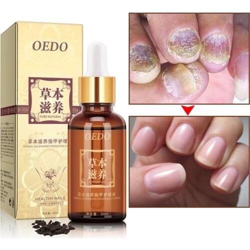 30ml Herbal Anti Fungal Nail Treatment Essential Oil Liquid Drops Toenail Care Fix & Renew
