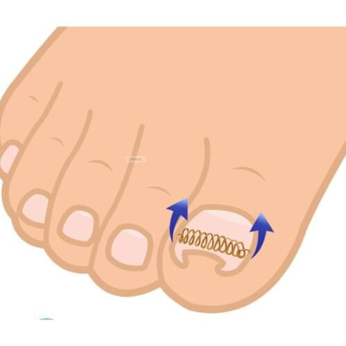 6pcs Toenail corrector Paronychia correction toe nail appliances curl armor recover foot care tools