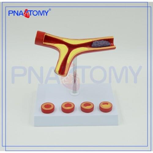 Arteriosclerosis Model with Thrombus Human Artery Anatomical Model Blood Vessel Medical Gift Teaching Tool Anatomy Body Parts