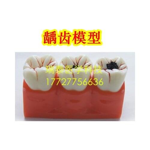 Human model Tooth model detachable medical Dental caries Tooth decay free shipping