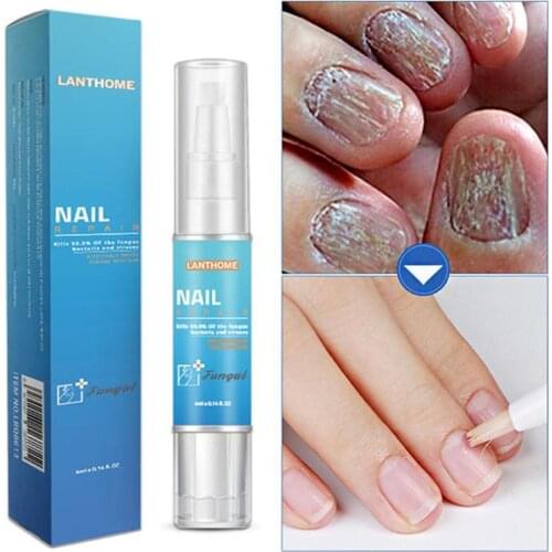Powerful Nail Treatment Pen Onychomycosis Paronychia Anti Fungal Nail Infection Chinese Herbal Toe Fungus Care Repair Serum