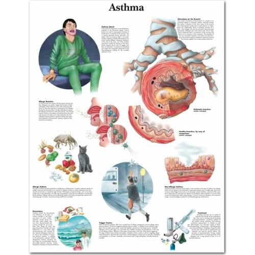 WANGART Asthma Chart Poster Print Canvas Painting Wall Pictures for Medical Education Doctors Office Classroom no frame