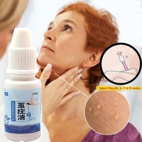 Genital Wart Treatment Papillomas Removal Of Warts Against Verruca Removing Remover Skin Liquid Remedy Anti From Moles F3W4