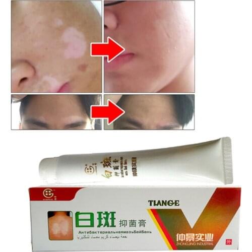 Chinese Medical White Spot Disease Cream Pigment Melanin Promoting Liniment Skin Vitiligo Leukoplakia Disease Treatment