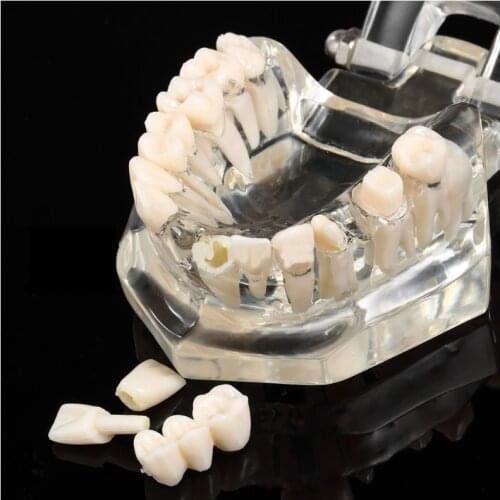Hot Sell Dental Implant Transparent Disease Removable Pathological Teeth Model