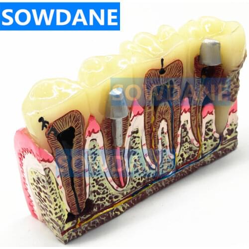 Dental Teeth Common Pathologies Model Teaching Model Tooth Dentist for Medical Science Teaching Dental Communication Model