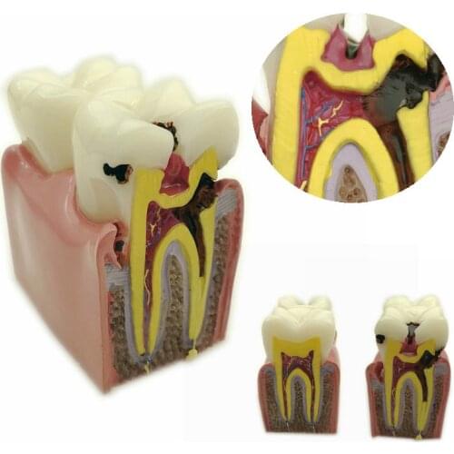 1pc Dental Anatomy Education Teeth Model 6 Times Caries Comparation Study Models For Dentist Studying and Researching