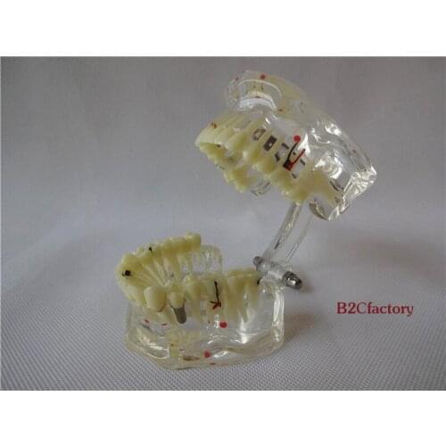 Dental Study Tooth Model Adult Pathological& Disease Teaching Teeth Model Removable For Free Shipping