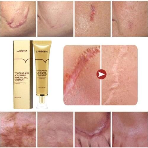Acne Scar Removal Cream Cosmetic For Face Screm Tcm Herbal Remove Skin Marks Stretch Bioaqua Care Repair Scar Treatment Q5B0