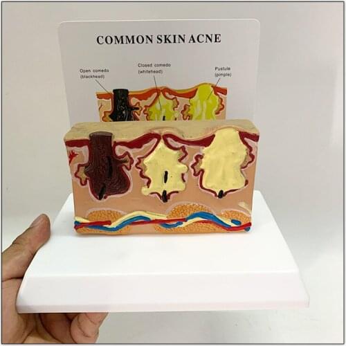 Common Skin Acne Enlarge Structure Anatomical Model Tissue Hierarchical Micro Plastic Surgery Suture Beauty Teaching