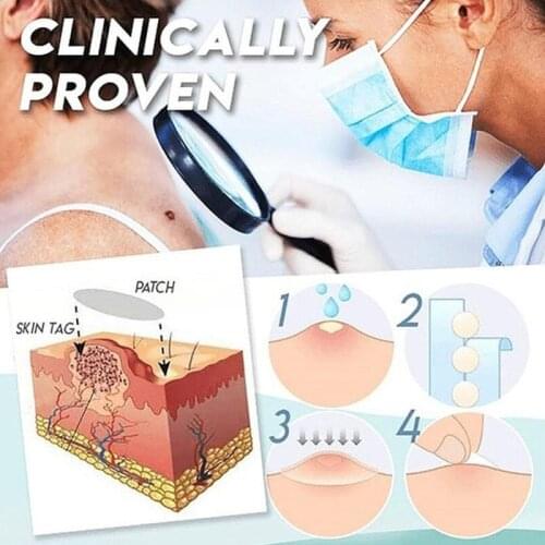 12 Hours Medical Fast Removal Mole Pen Beauty Removing From Skin Tag Genital Wart Liquid Remover Of Warts Anti Verruca Remedy
