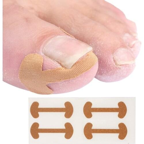 20pcs Professional Embedded Toe Nail Corrector Sticker Toenail Care Pedicure Thumb Curl Correction Sticker Nail Care