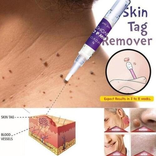 Warts Warts Flat Warts Skin Repair No Trace Beauty Papilloma Pen Of Removal Skin Mole Liquid Warts Treatment