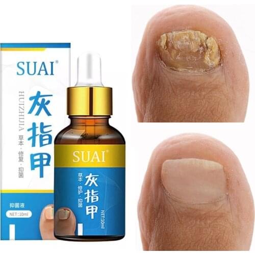 SUAI 10ML Nail Fungal Treatment Feet Care Essence Nail Foot Toe Nail Fungus Removal Gel Anti Infection Paronychia Onychomycosis