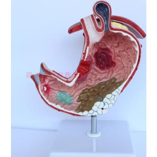 Stomach Lesion Anatomy Model Stomach Disease Demonstration Pathology Model