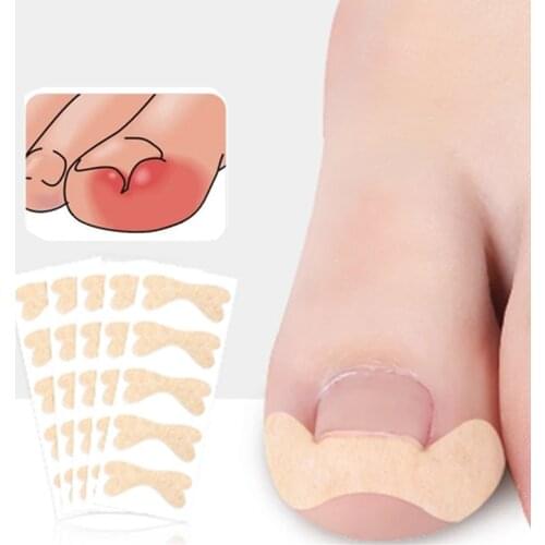 10/20/30 Ingrown Toenail Corrector Sticker Paronychia Treatment Fixer Recover Corrector bunion Pedicure Foot Toe Nail Care Tool