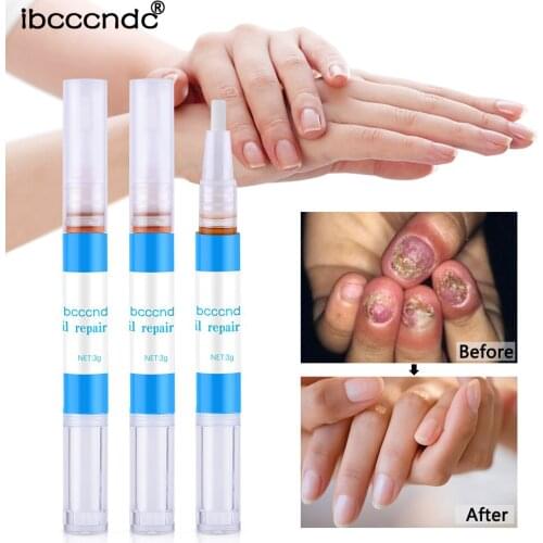 Nail Fungus Repair Treatment Pen Products Onychomycosis Paronychia Anti Fungal Nail Infection Chinese Herbal Care Oil Pen TSLM1