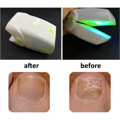 Rechargeable Low Level Laser Therapy Device Lllt No Pain Finger Nail Fungus Toe Nail Disease Onychomycosis Infections Treatment