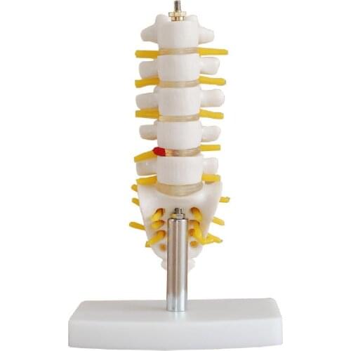 Mini Lumbar Vertebrae with Sacrum & Coccyx and Herniated Disc