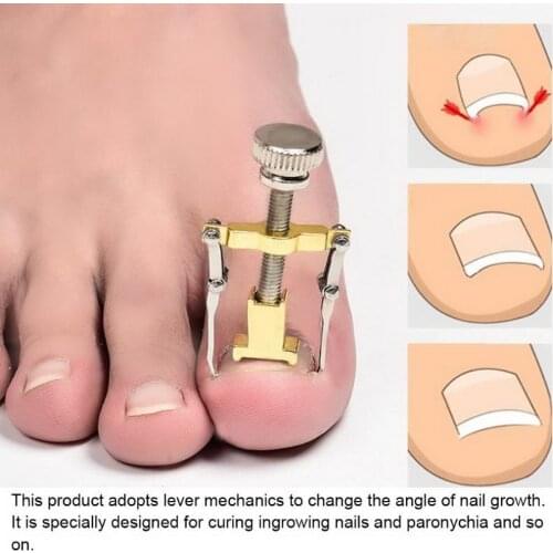 Ingrown Toe Nail Correction Tool Fixer Recover Toe Paronychia Nail Brace Tools Ingrown Toenails Pedicure Tool
