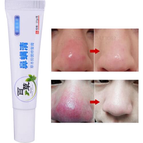 Herbal Anti Nose Mites Remove Acne Rosacea Cream Red Nose Blackhead Remover Acne Treatment Shrink Pores Face Bleaching Ointment