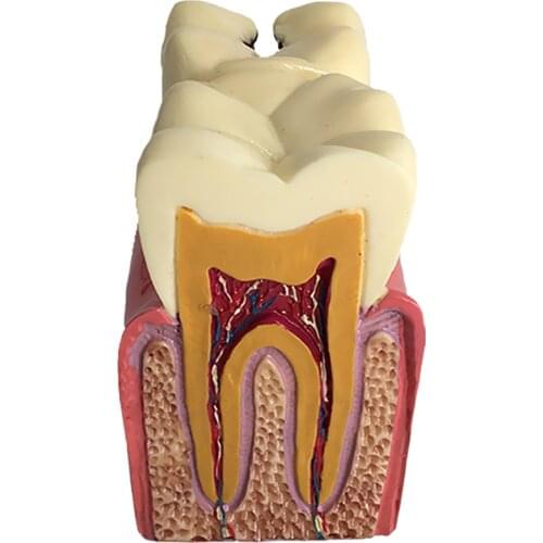 1 Piece Caries Tooth Model Caries Comparison Study Form Professional Learning