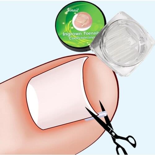 10 Piece Ingrown Pads Nail Groove Orthopedic Pads Nail Correction Devices Correction Treatments Sticker Patch Foot Care Tools