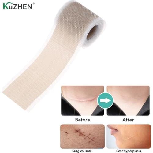 1Roll Self-Adhesive Silicone Gel Tape Patch For Acne Burn Scar Reduce Silicone Gel Efficient Beauty Scar Removal Silicone Gel