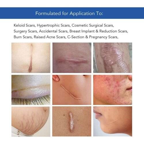 Beauty Scar Removal Sticker Silicone Intensive High-viscosity burns Sticker and Scar eliminate Skin scars acne wounds Can T E4T6