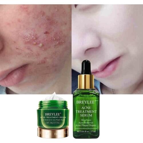 BREYLEE 2Pcs for Acne Treatment Serum and Anti-acne Cream Suit Acne Removal Acne Pimple Whitening Moisturizing Skin Care
