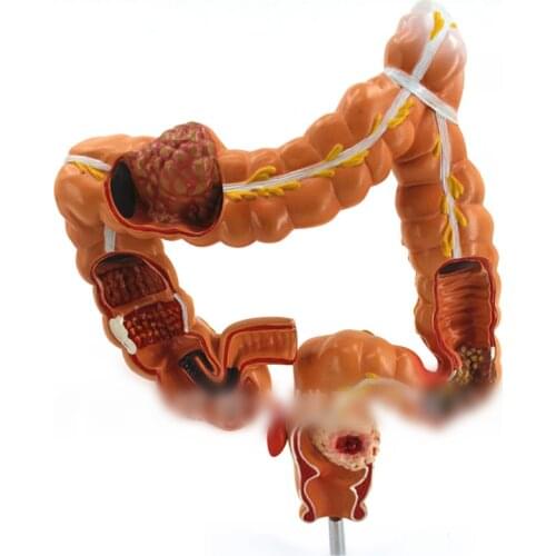 Colon pathological model colorectal lesions specimen intestinal doctor-patient communication human organ anatomy