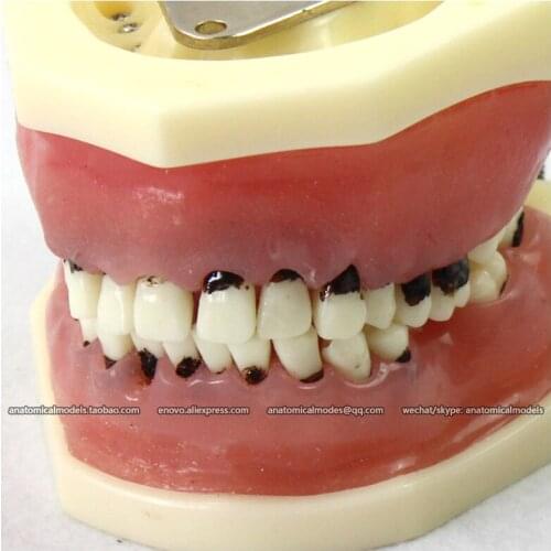 CMAM/12610 Dental- Periodontal disease, Human Oral Dental Medical Teaching Anatomical Model