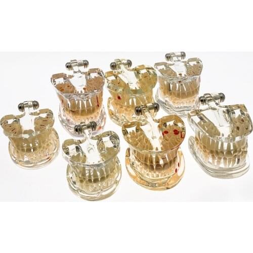 Adult /Children Pathological Teeth Model Dental Lab Equipment Dentist Doctor-patient Communication