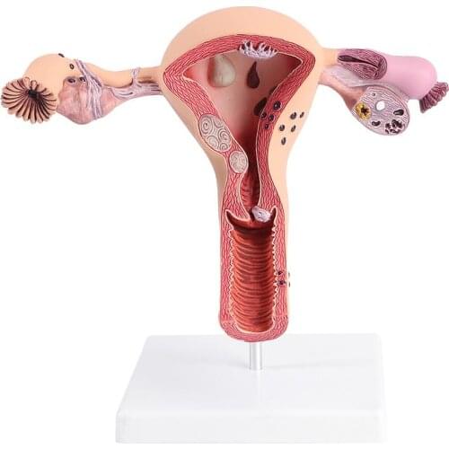 1Pc Practical Uterus Model Female Reproductive System Model For Medical Training Human Uterus Model Pathological Uterus Model