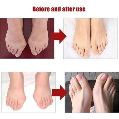 Silicone Gel Thumb Straightener Bunion Corrector Orthopedic Straightener Tool Protector Big Corrector Toe Feet Foot Care E5Q8