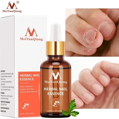 30ML Fungal Nail Treatment Serum Onychomycosis Paronychia Anti-Fungal Nail Infection Herbal Toe Fungus Foot Repair Essence Care