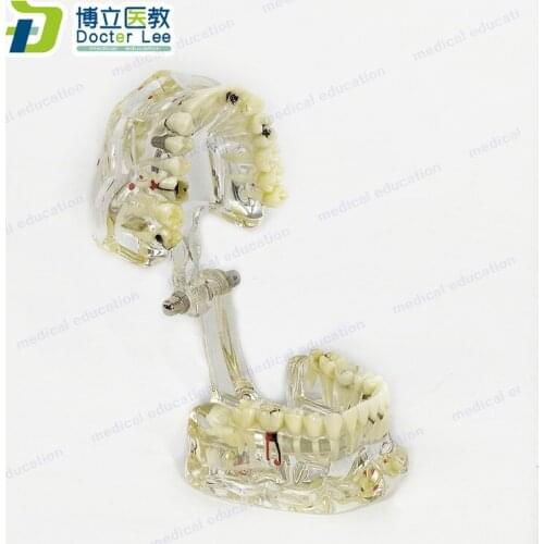 Pathological Model of Transparent Resin Teeth Dental Lab Equipment Dentist Teaching and Medical Science