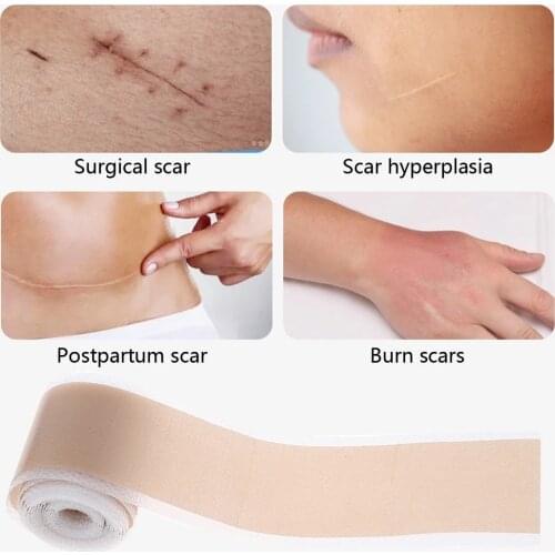 Efficient Scar Removal Silicone Gel Tape Self-Adhesive Patch For Acne Burn Reduce Beauty Tool Medical Grade Wound Dressing