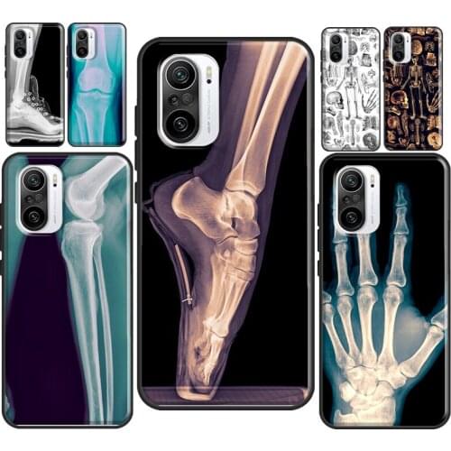 X-Ray Human Anatomy For Xiaomi Mi 10T Pro 9T Mi Note 10 Lite 11 Ultra Case For POCO M3 F3 X3 Pro Back Cover