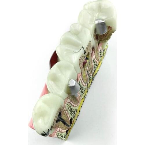 Communication Demonstration Dental Anatomy Caries Oral Model Medical Teaching Study Communication