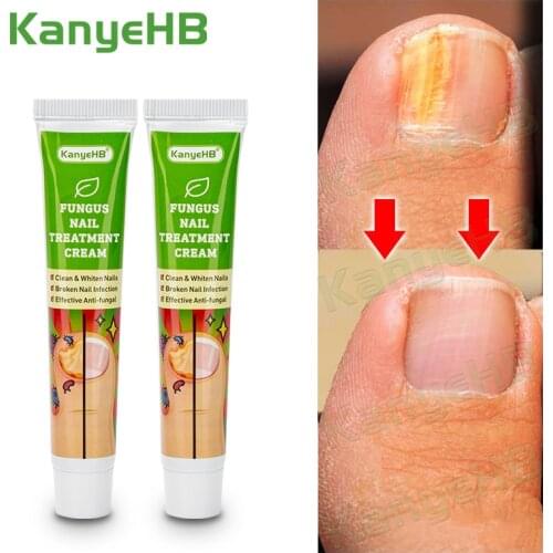2pcs Nail Fungus Removal Cream Onychomycosis Fungal Nail Treatment Paronychia Anti Infection Toe Fungal Nail Care Ointment A652