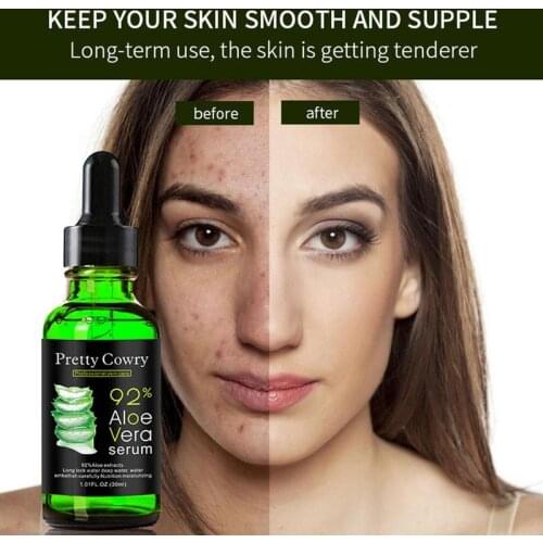 Aloe Vera Serum Acne Scar Removal Essence Acne Spots Whitening Skin Care Treatment Care Remove 30ML Face Acne dropshipping