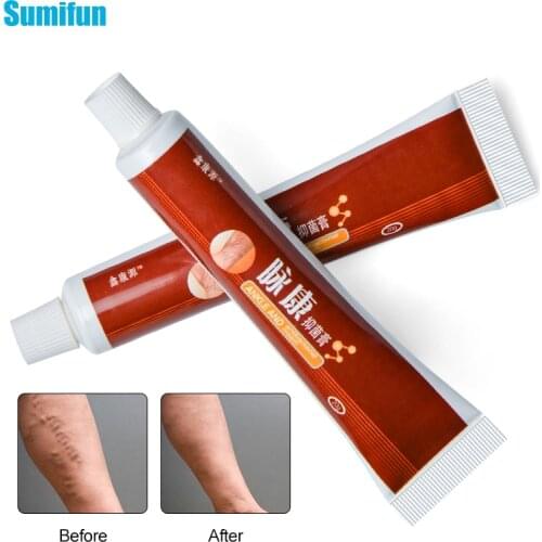 Varicose Veins Treatment Ointment For Vasculitis Phlebitis Blood Vessel Rotten legs Angiitis Cream Medical Plaster