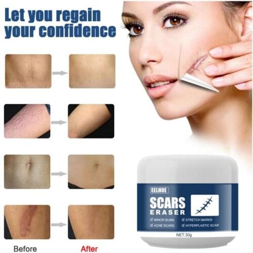 Advanced Treatment For Face & Body Old & New Scars From Cuts,Stretch Marks,C-Sections & Surgeries Skin Care Scar Removal Cream