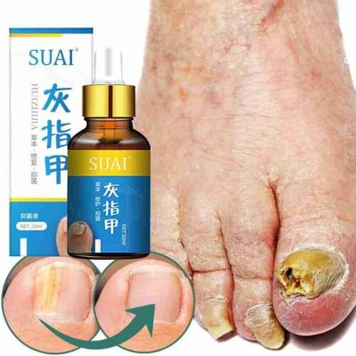 Nail Fungal Treatment Feet Care Essence Nail Foot Whitening Toe Nail Fungus Removal Gel Anti Infection Paronychia Onychomycosis